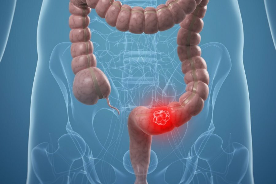  Right Hemicolectomy 