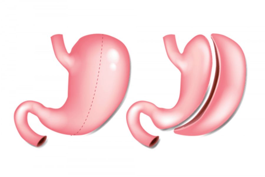  Laparoscopic Gastrectomy 