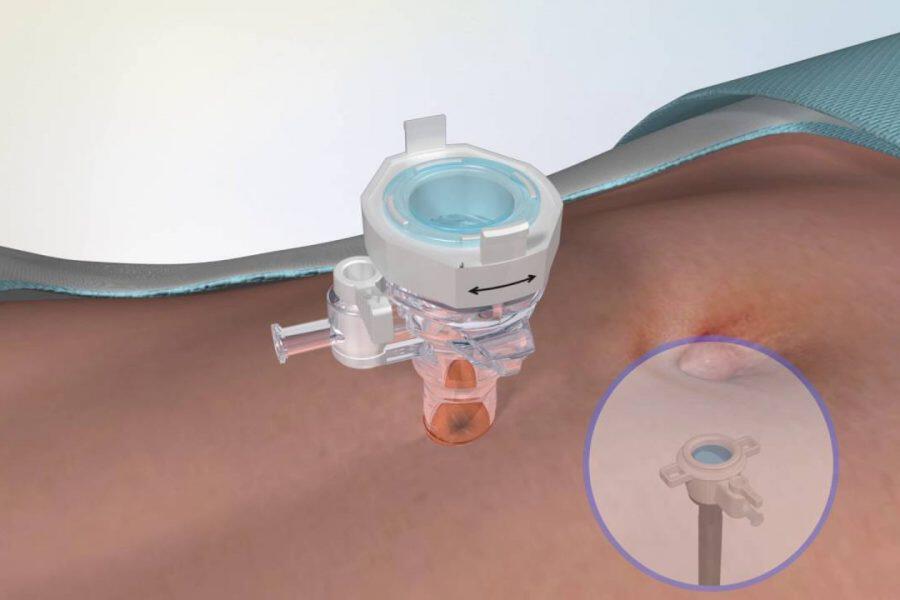  Laparoscopic Hiatal Hernia Repair 