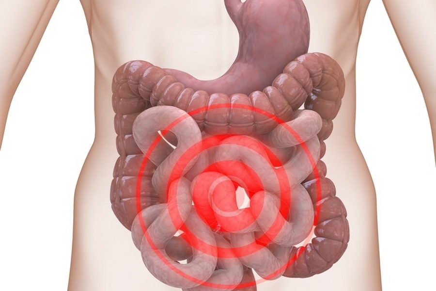  Sigmoid Colectomy 