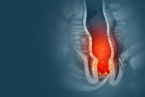  Hemorrhoids 